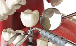 Kumluca'da Devlet Destekli İmplant Diş Tedavisi Dönemi Başladı