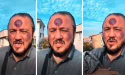 Hacamat Sonrası Yüzü Moraran Adam Tavsiyesinden Vazgeçmedi