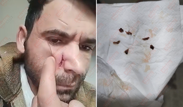 Hastanede Skandal İddia: 20 Dakikalık Ameliyat Kabusa Döndü