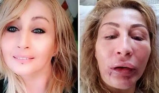 Estetik Sonrası Açılan Davada 994 Bin TL Tazminat Kararı