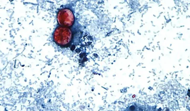 ABD'deki Cyclospora Salgını Türkiye İçin De Uyarı Oldu