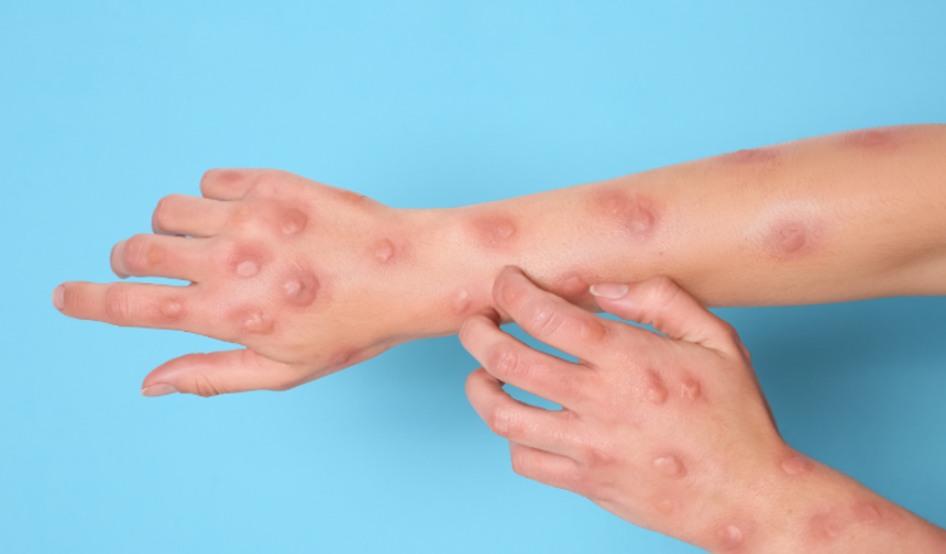 Maymun Çiçeği Varyantı Alanya'da Tehlike Yarattı