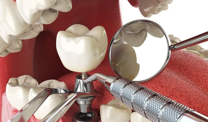 Kumluca'da Devlet Destekli İmplant Diş Tedavisi Dönemi Başladı