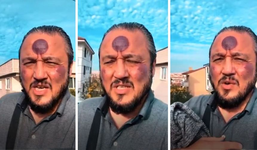 Hacamat Sonrası Yüzü Moraran Adam Tavsiyesinden Vazgeçmedi